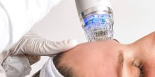 RF microneedling device