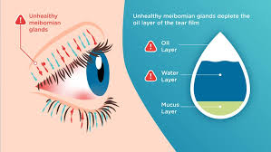 Dry Eye diagnostics & therapy