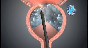 Fibers and consumables